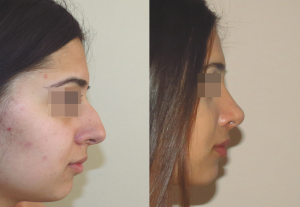 Фото до и после ринопластики у пластического хирурга Геворга Степаняна