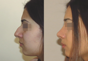 Фотографии до и после ринопластики у пластического хирурга Геворга Степаняна