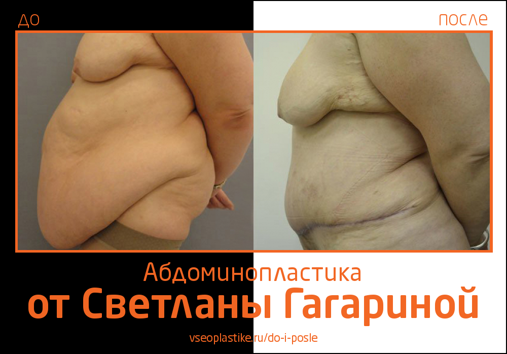 Светлана Гагарина. Фото до и после абдоминопластики