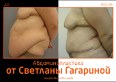 Светлана Гагарина. Фото до и после абдоминопластики