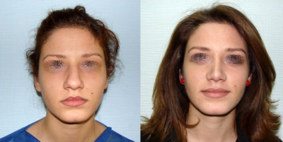 Фото до и после ринопластики у пластического хирурга Гайка Бабаяна