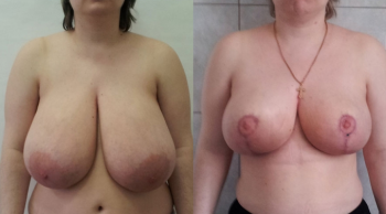 Фото до и после уменьшения груди у Александра Абакумова