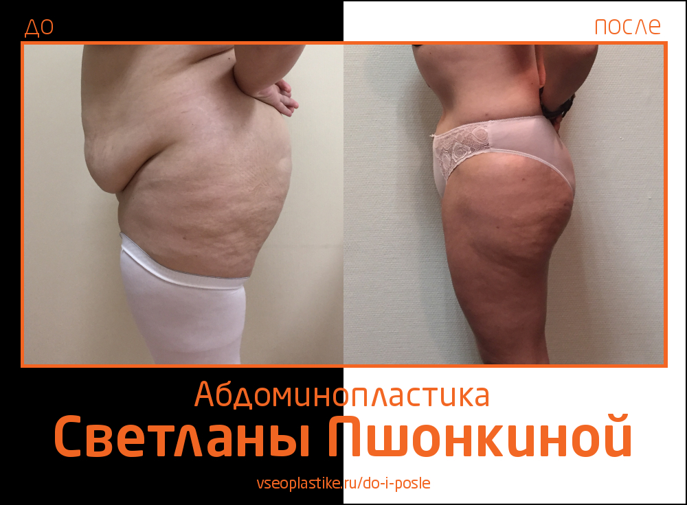 Светлана Пшонкина. Фото до и после абдоминопластики