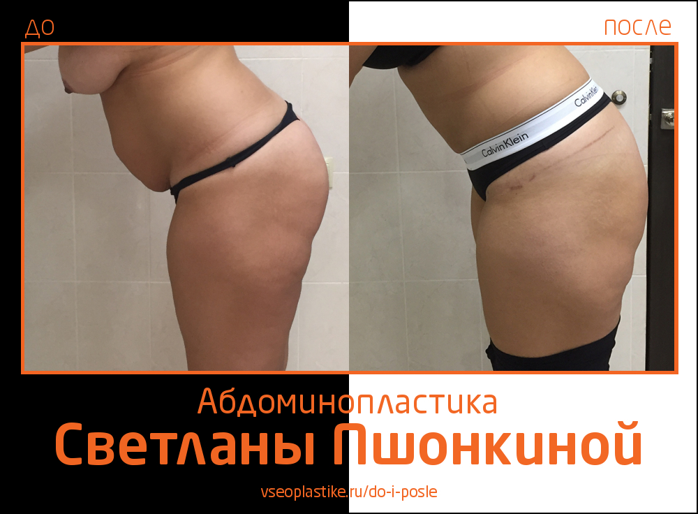 Светлана Пшонкина. Фото до и после абдоминопластики