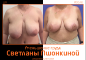 Светлана Пшонкина. Фото до и после уменьшения груди
