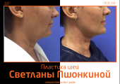 Светлана Пшонкина. Фото до и после подтяжки шеи