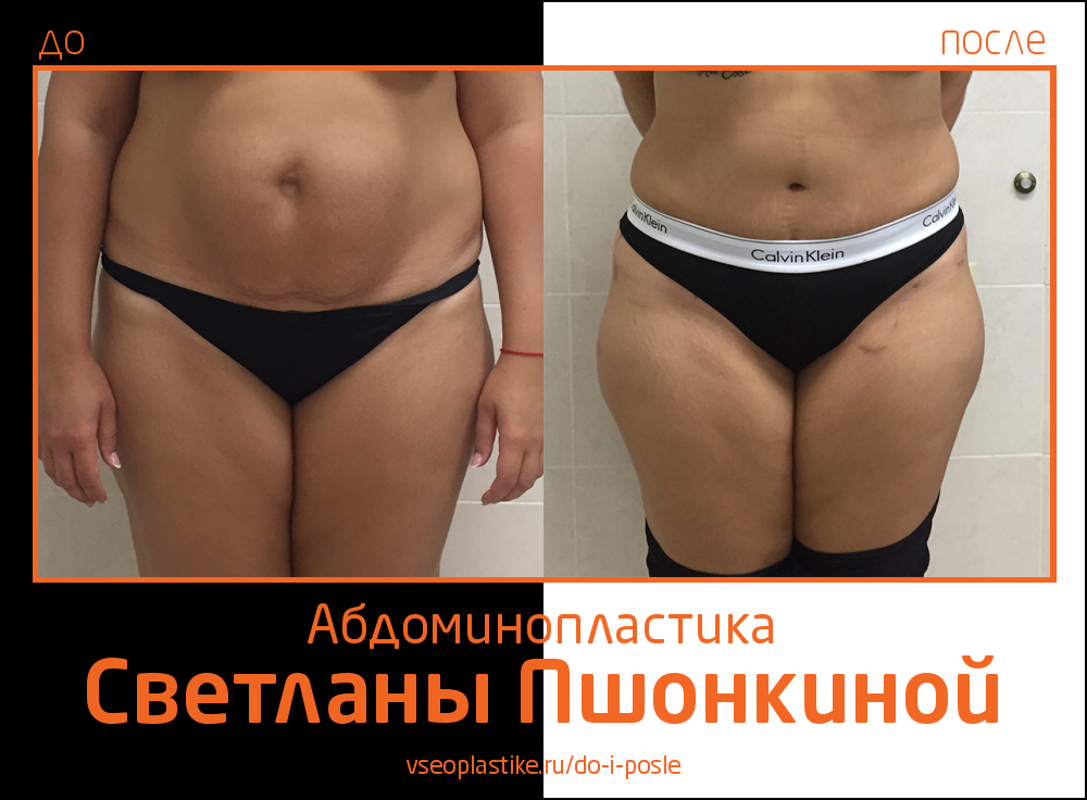 Светлана Пшонкина. Фото до и после абдоминопластики