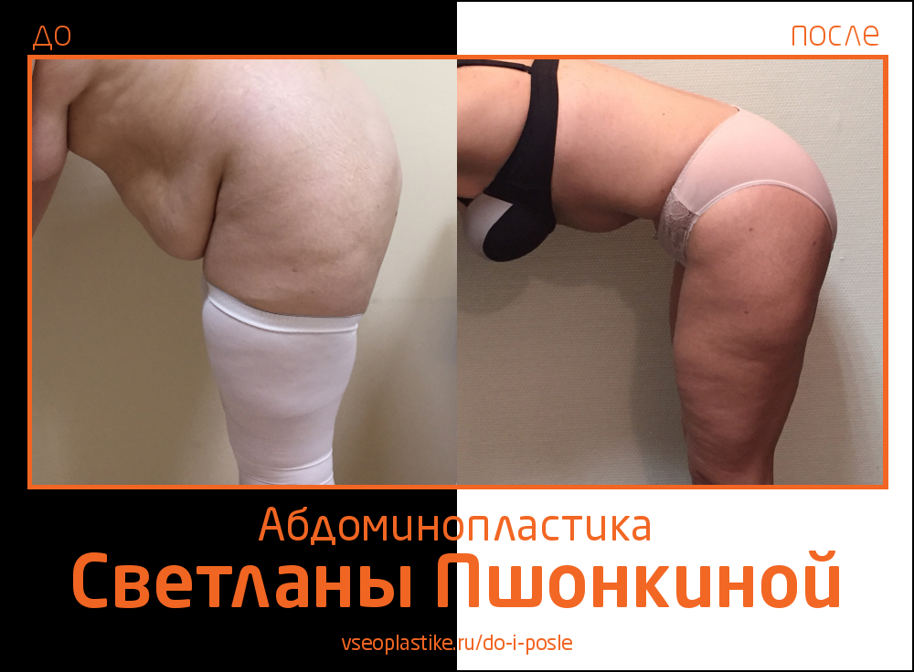 Светлана Пшонкина. Фото до и после абдоминопластики