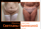 Светлана Пшонкина. Фото до и после абдоминопластики