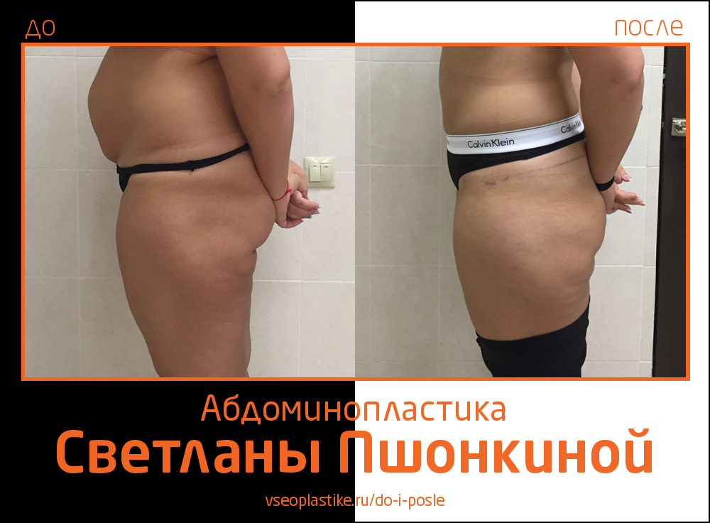 Светлана Пшонкина. Фото до и после абдоминопластики