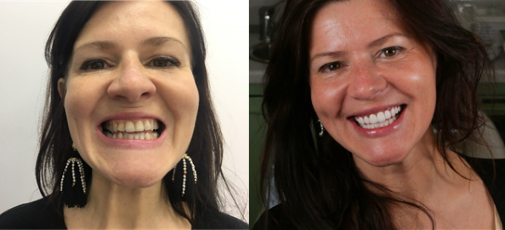 Юлие провели коррекцию зубов для создания красивой улыбки