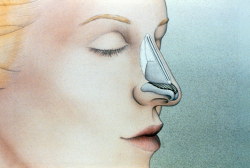 Костная мозоль после ринопластики: причины, профилактика, устранение