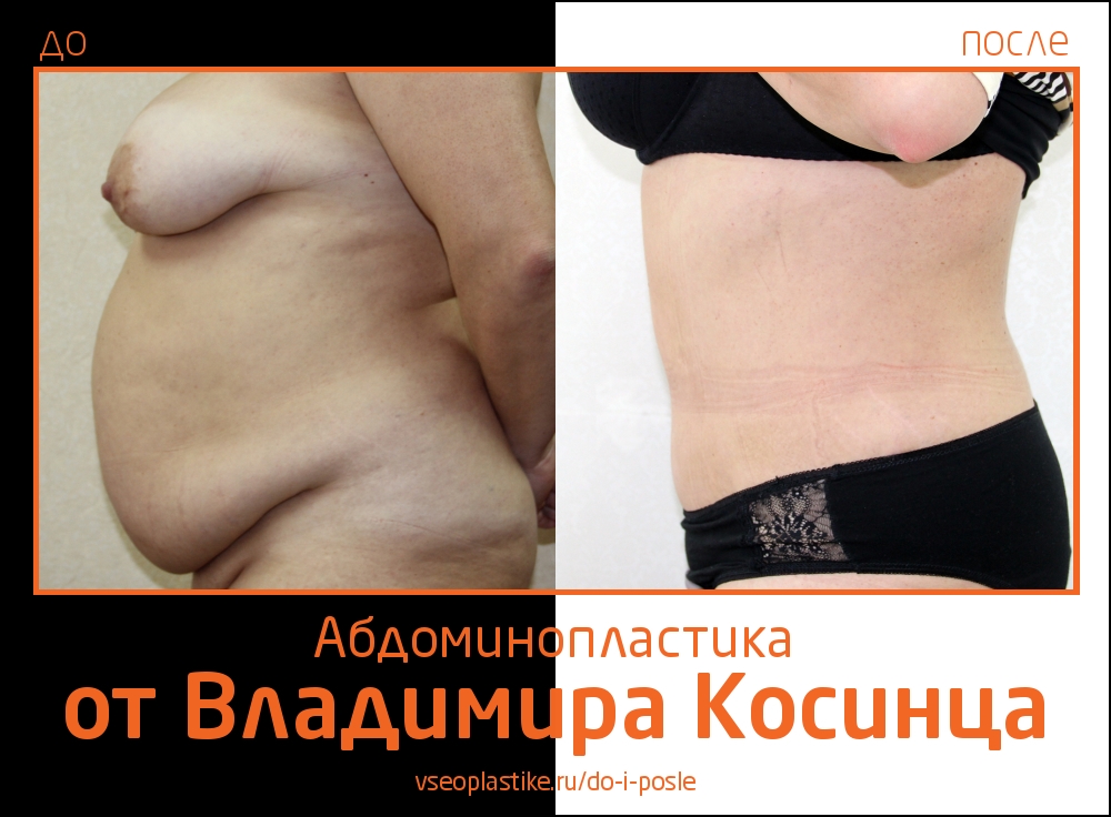 Владимир Косинец. Фото до и после абдоминопластики