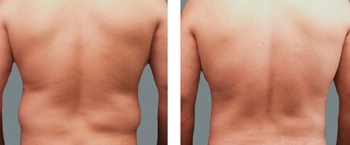 Фото до и после липосакции боков