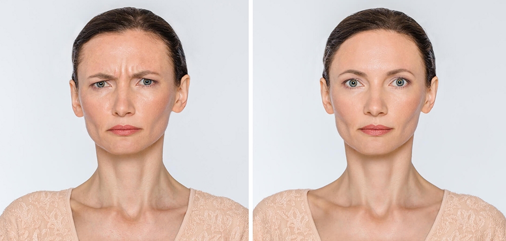 Блефаропластика до и после