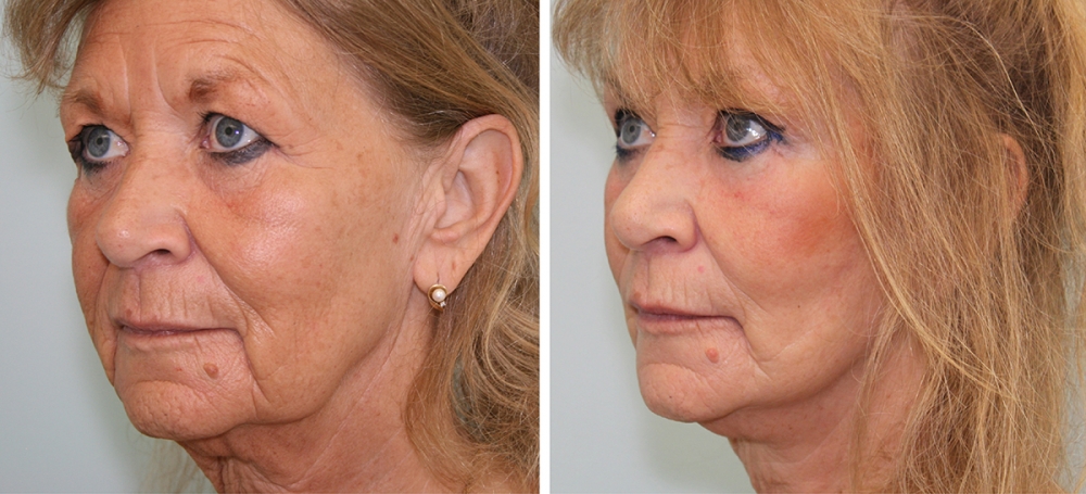 Подтяжка лица. Фото до и после