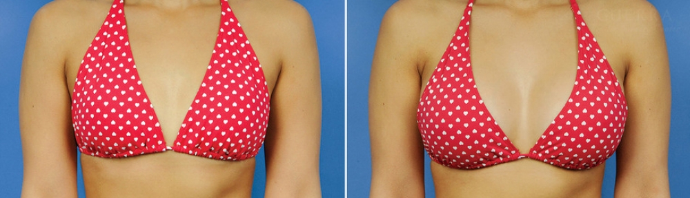 Увеличение груди фото до и после