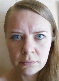 Эндоскопическая подтяжка лба и риносептопластика у Александра Грудько