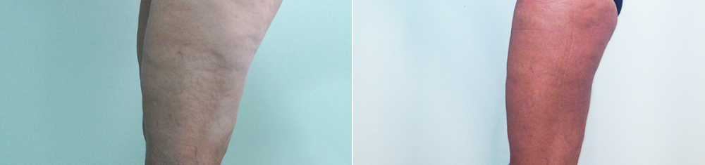 До и после радиочастотной липосакции ног у пластического хирурга Светланы Пшонкиной