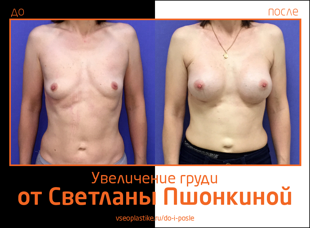 Светлана Пшонкина. Фото до и после увеличения груди