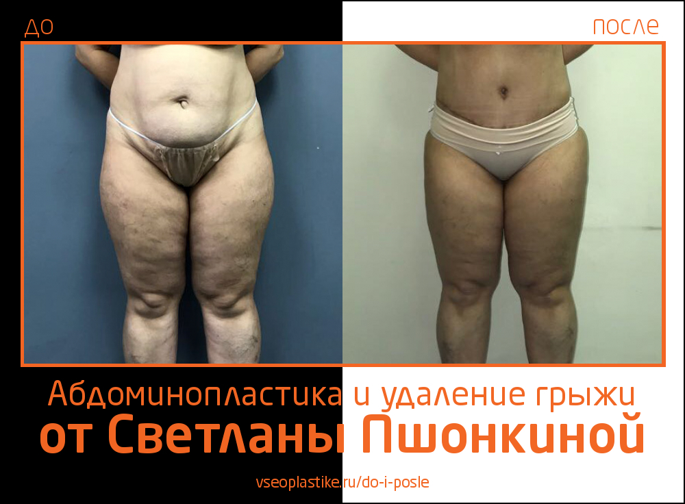 Светлана Пшонкина. Фото до и после абдоминопластики с удалением грыжи