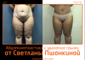 Светлана Пшонкина. Фото до и после абдоминопластики с удалением грыжи