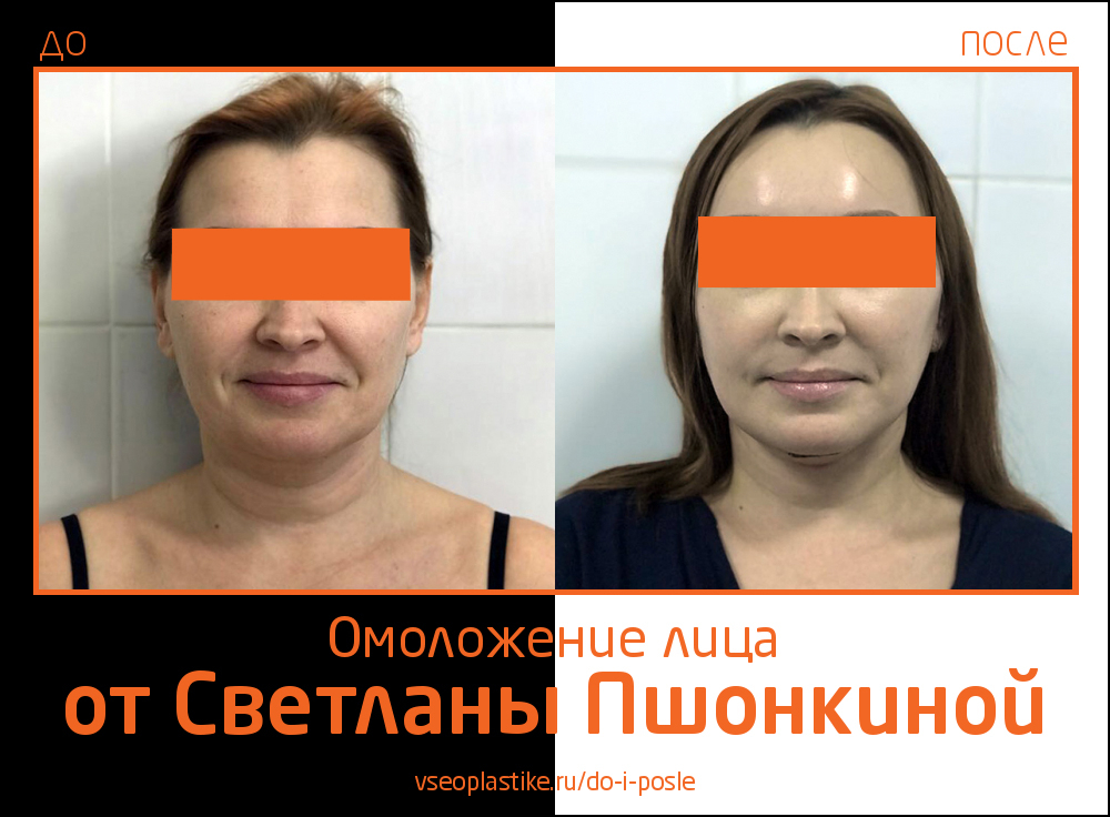 Фото до и после омоложения лица пластическим хирургом Светланой Пшонкиной