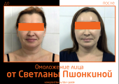 Фото до и после омоложения лица пластическим хирургом Светланой Пшонкиной