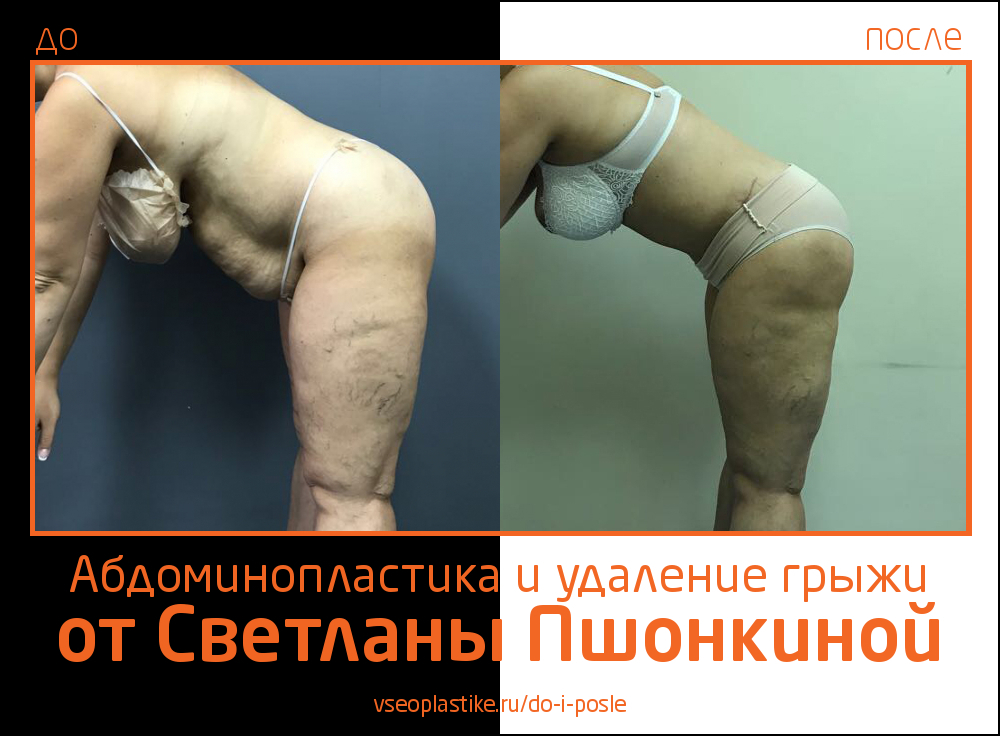 Фото до и после абдоминопластики с удалением грыжи  пластическим хирургом Светланой Пшонкиной