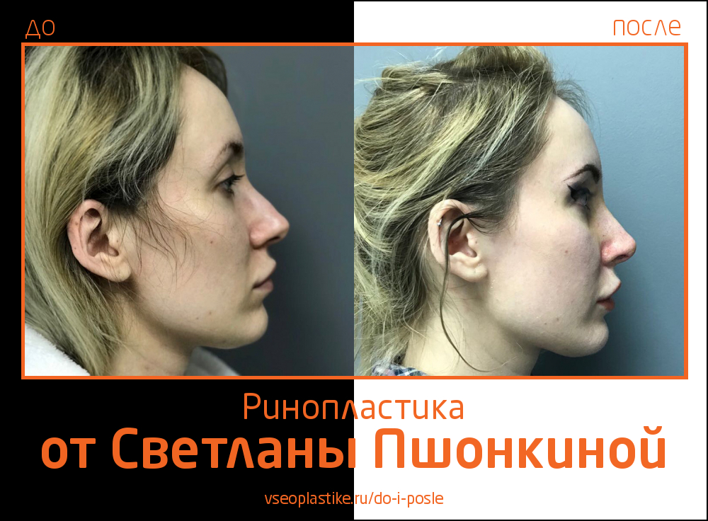 Светлана Пшонкина. Фото до и после ринопластики