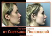 Светлана Пшонкина. Фото до и после ринопластики