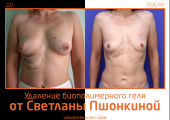 Светлана Пшонкина. Фото до и после удаления биополимерного геля из груди