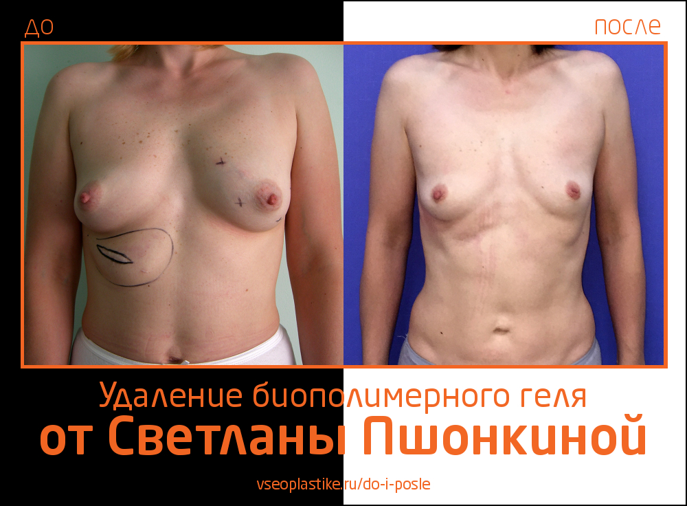 Светлана Пшонкина. Фото до и после удаления биополимерного геля из груди