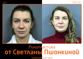 Светлана Пшонкина. Фото до и после ринопластики