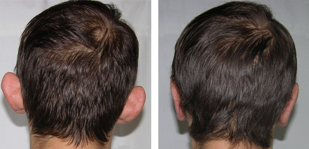 Отопластика у Александра Гуляева