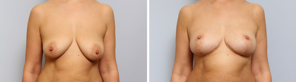 Подтяжка груди у Сергея Свиридова