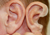 Пациентам пересадили уши, выращенные из их собственных клеток