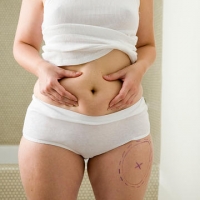 Абдоминопластика в Москве