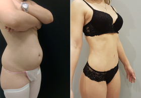 Программа послеродового восстановления AfterBaby у пластического хирурга Владимира Зленко