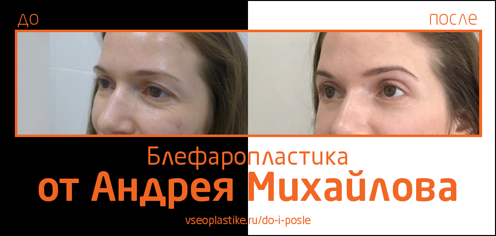 Андрей Михайлов. Фото до и после блефаропластики
