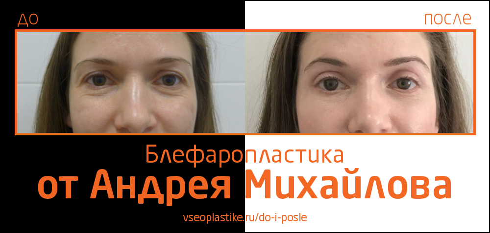 Андрей Михайлов. Фото до и после блефаропластики