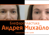 Андрей Михайлов. Фото до и после блефаропластики