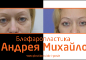 Порой достаточно сделать небольшую коррекцию в области век, чтобы помолодеть. Пример тому — пациентка доктора Андрея Михайлова.