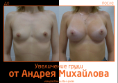 Андрей Михайлов. Фото до и после увеличения груди