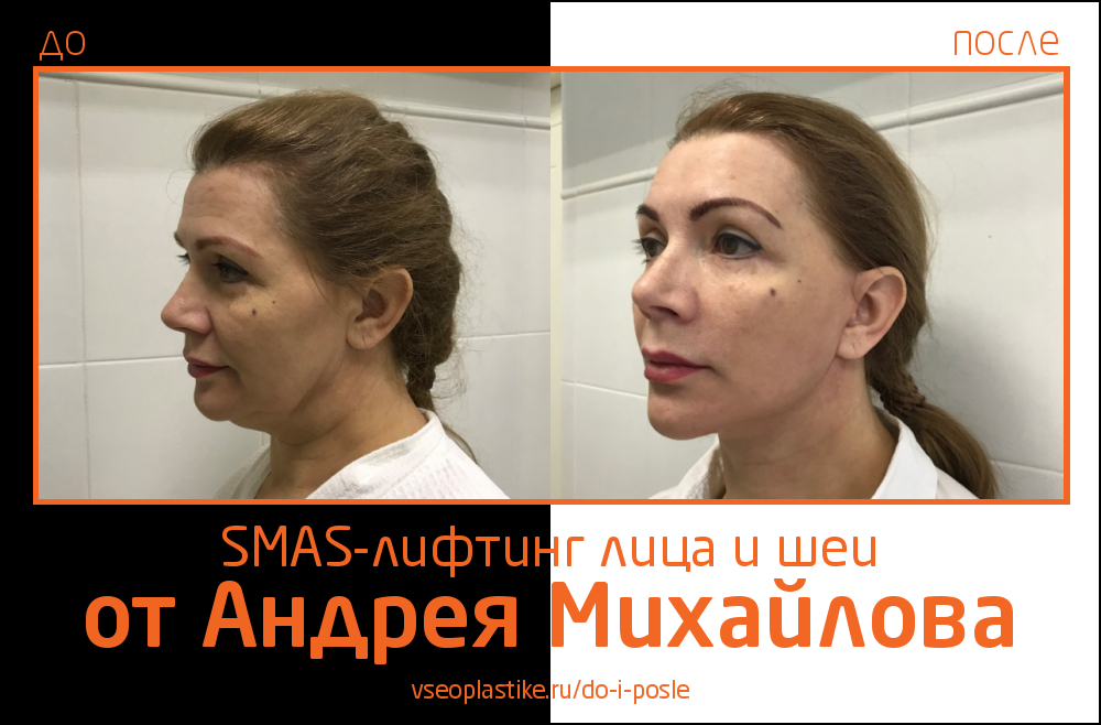 Андрей Михайлов. Фото до и после SMAS-лифтинга лица и шеи
