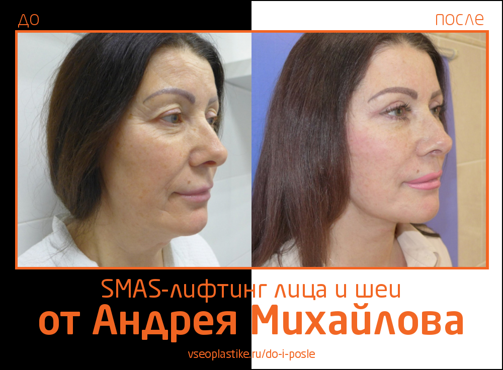 Андрей Михайлов. Фото до и после SMAS-лифтинга лица и шеи