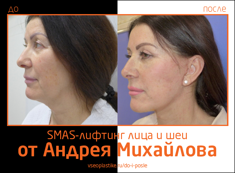 Андрей Михайлов. Фото до и после SMAS-лифтинга лица и шеи