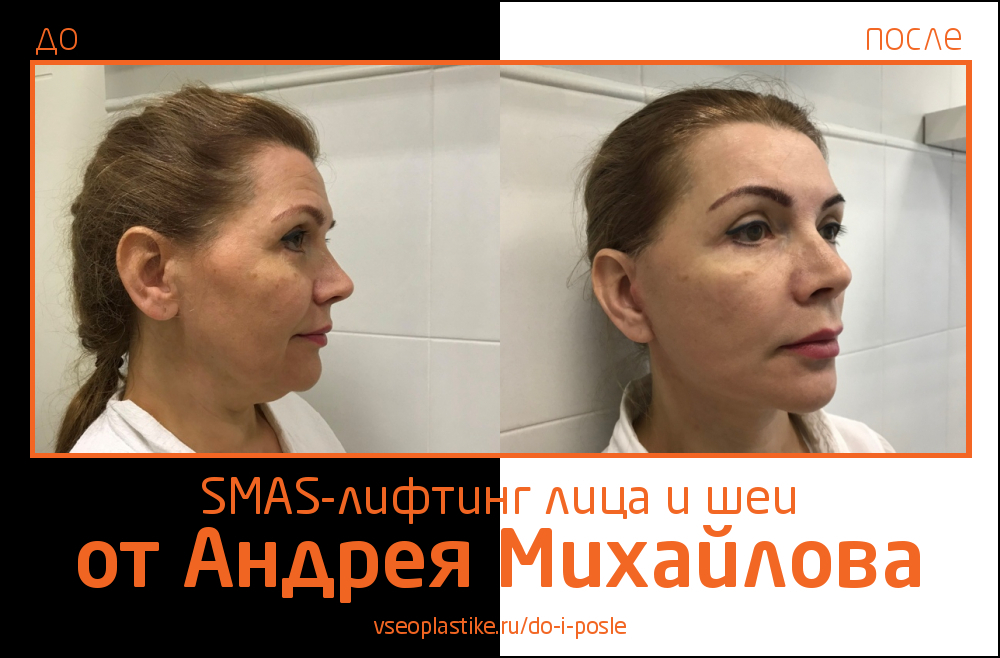 Андрей Михайлов. Фото до и после SMAS-лифтинга лица и шеи
