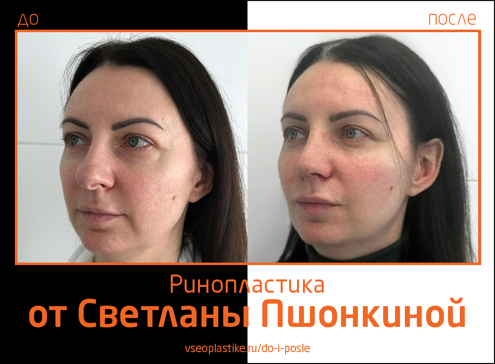 Светлана Пшонкина ринопластика