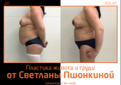 Светлана Пшонкина. Фото до и после абдоминопластики и пластики груди
